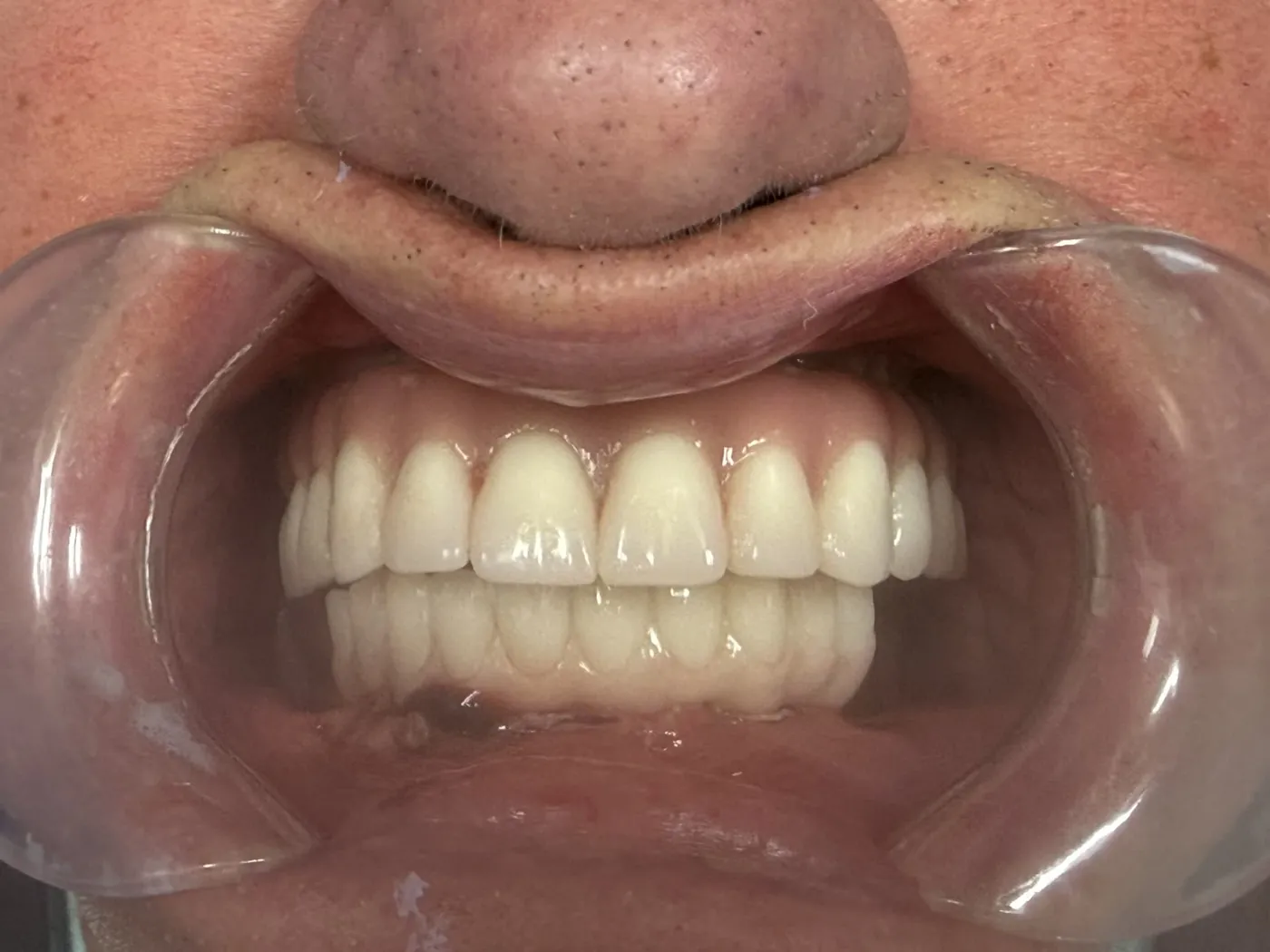 Foto clínica con la boca abierta y un retractor de labios que muestra dientes fijos superiores e inferiores de arcada completa, parejos, blancos y de aspecto natural