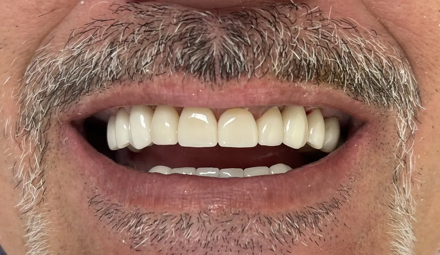 Primer plano de una sonrisa con dientes superiores e inferiores parejos y muy blancos