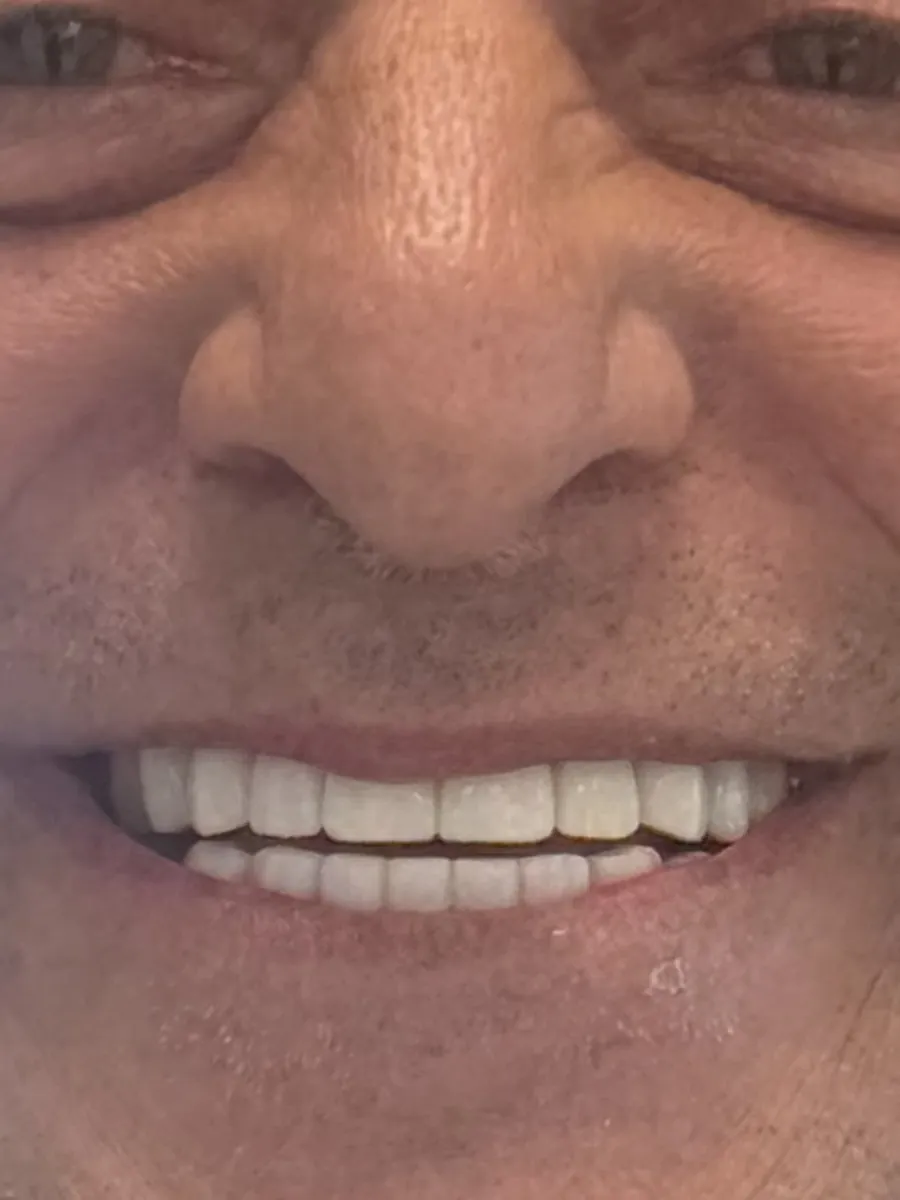 Parte inferior de un rostro sonriendo con todos los dientes blancos y parejos