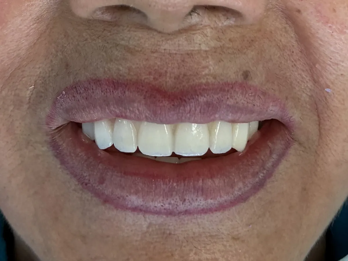 Primer plano de una sonrisa con una arcada superior de aspecto natural y bien alineada